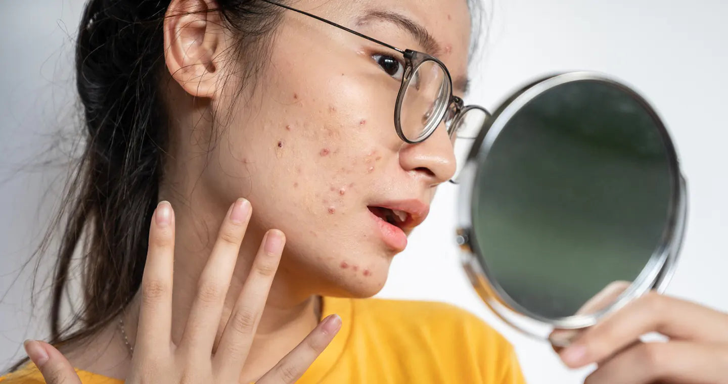 Most Effective Clinical Treatments for Acne