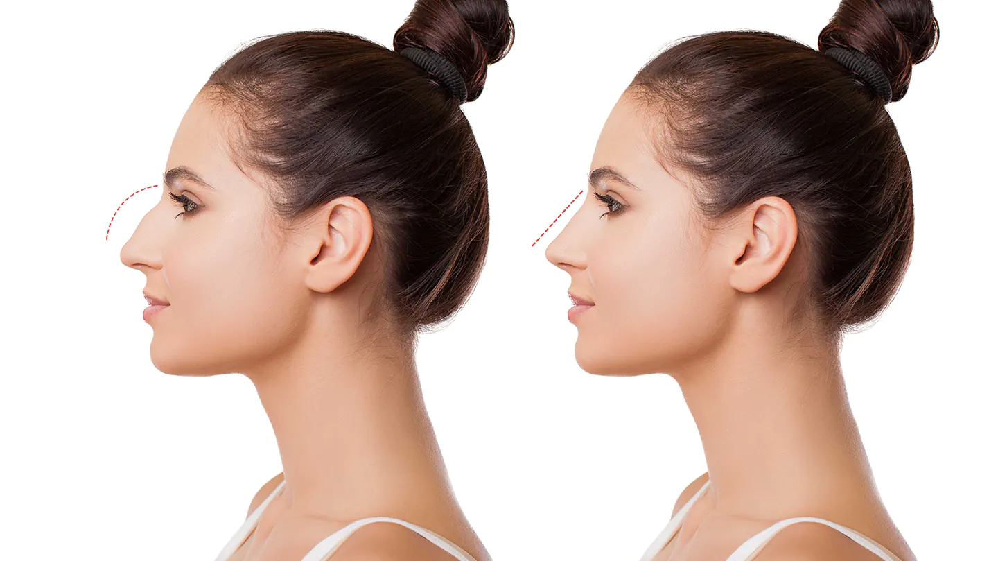 Non-Surgical Rhinoplasty vs Surgical Nose Job